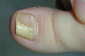 Os motivos da aparición do fungo no dedo pulgar da perna