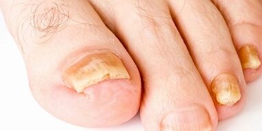 Como e como curar o fungo das uñas