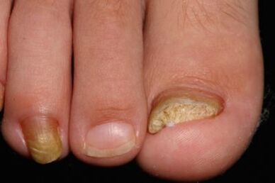 Micose de uñas nas pernas