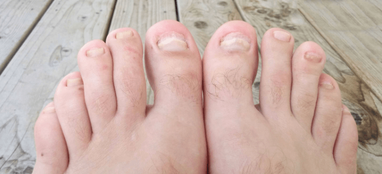 Fungo das uñas