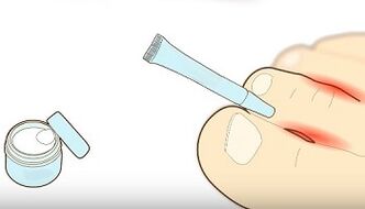 Como tratar o fungo nos dedos dos pés