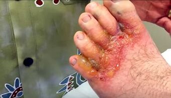 síntomas de fungo nos dedos dos pés
