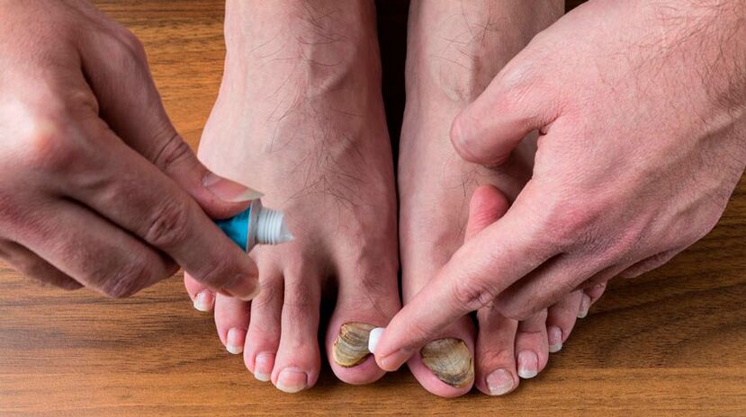 Aplicación de crema antifúngica nas uñas dos pés para tratar a onicomicose